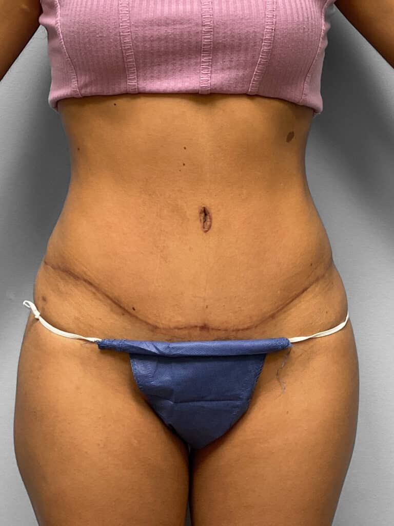 After Image: Tummy Tuck, Lipo, & BBL- Dr. Tucker - front