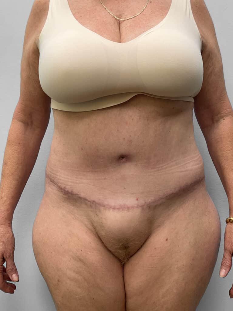 After Image: Abdominoplasty & Lipo- Dr. Howell - front