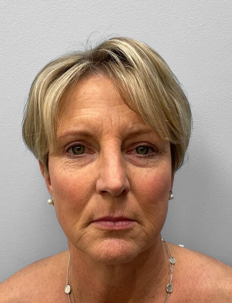 After Image: Blepharoplasty & Laser Resurfacing- Dr. Howell - front