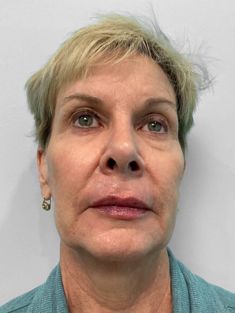 After Image: Juvederm Volbella- Heather - front