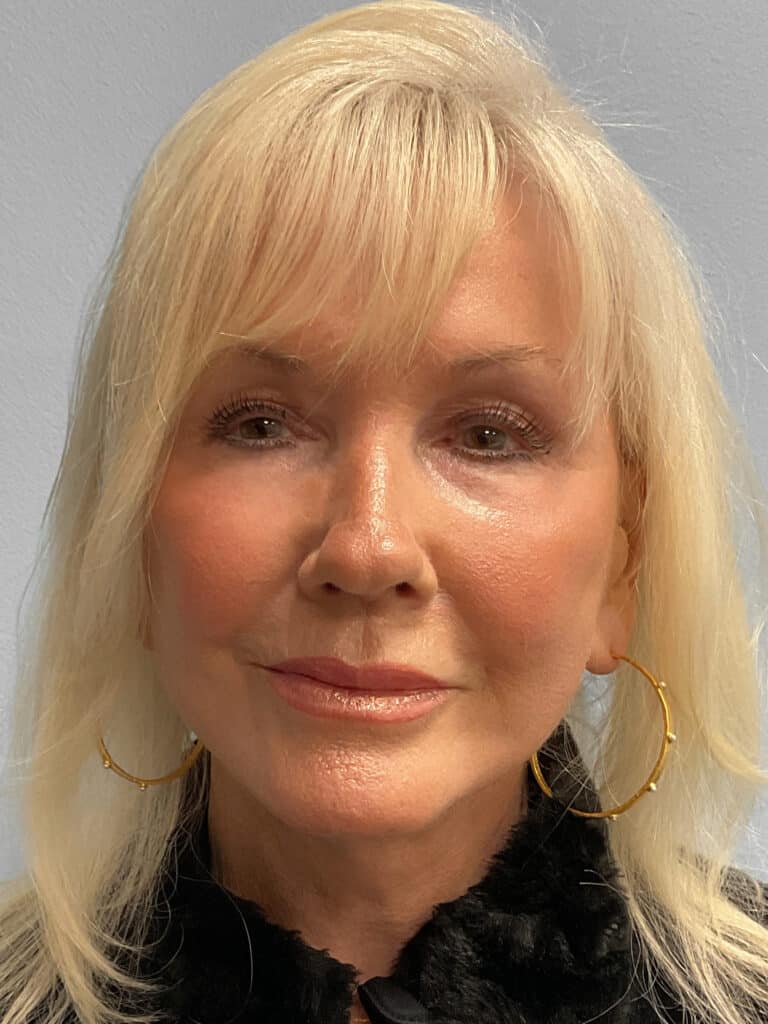 After Image: Facelift & TFX- Dr. Tucker - front