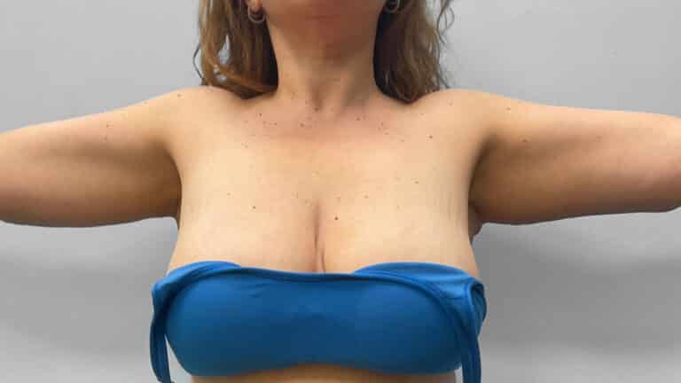 After Image: Arm Lift- Dr. Tucker - front
