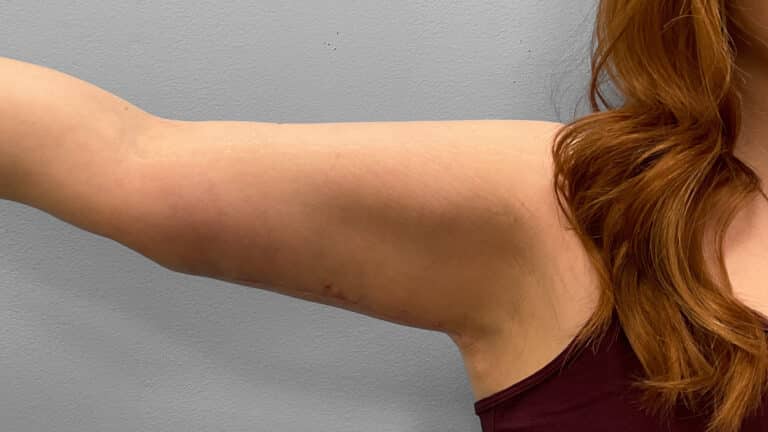 After Image: Arm Lift- Dr. Tucker - right-side