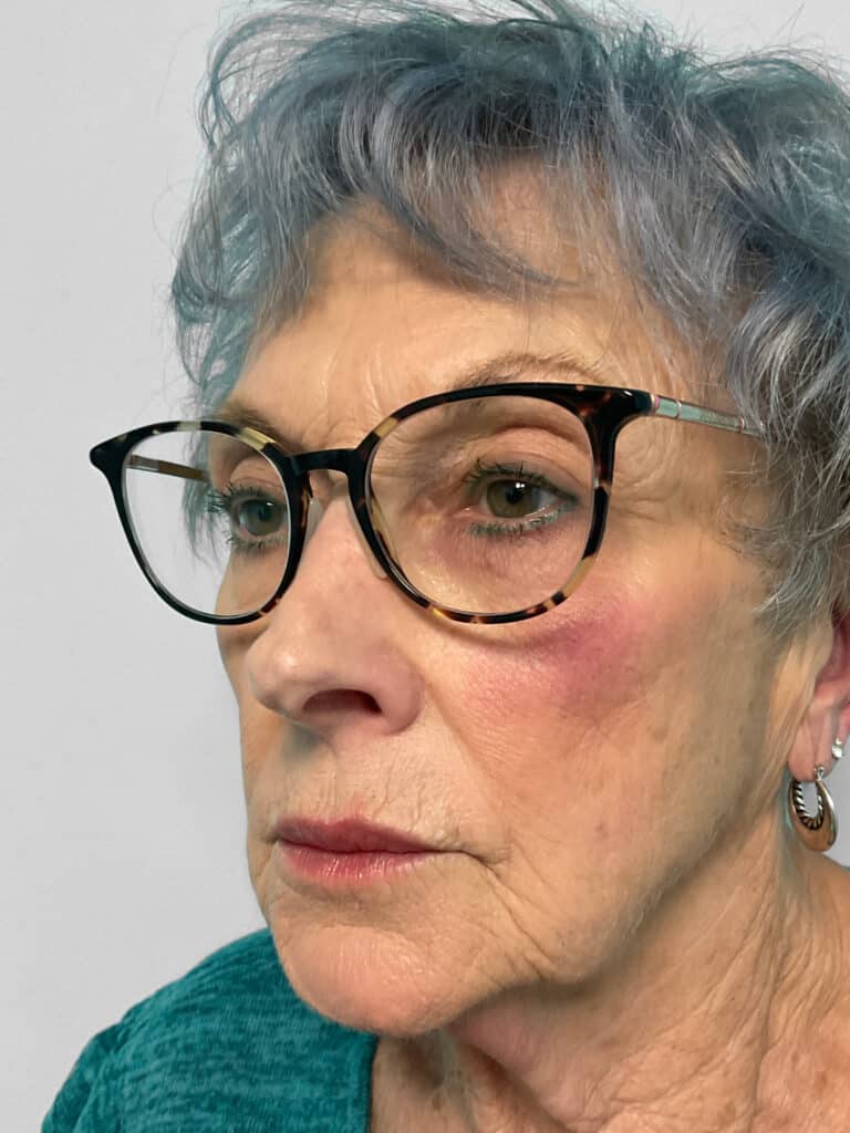 After Image: Botox & Restylane Kysse- Heather - left-front-oblique
