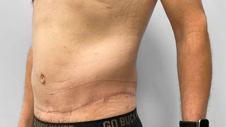 After Image: Body Lift- Dr. Tucker - left-front-oblique