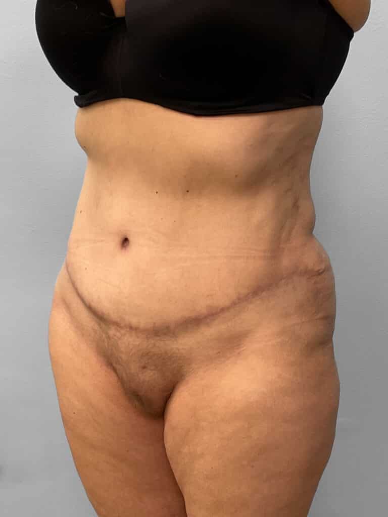 After Image: Tummy Tuck & Liposuction- Dr. Tucker - left-front-oblique