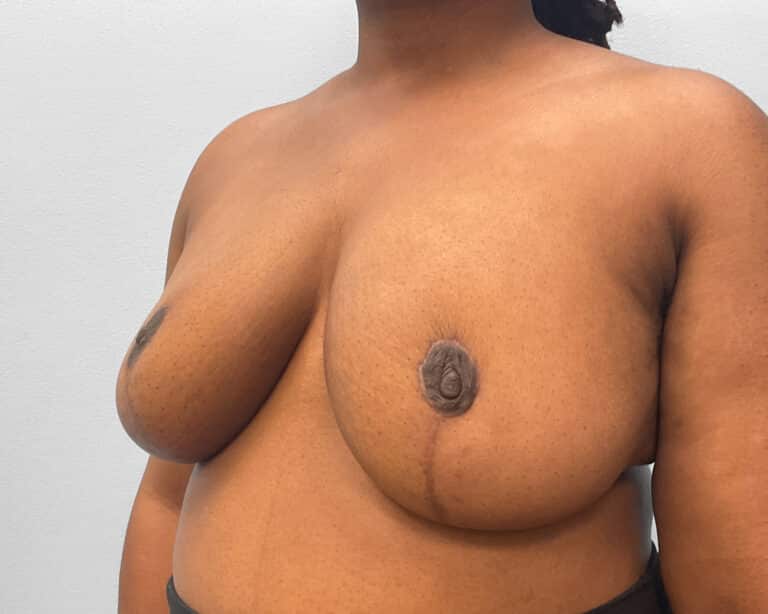 After Image: Breast Reduction- Dr. Tucker - left-front-oblique