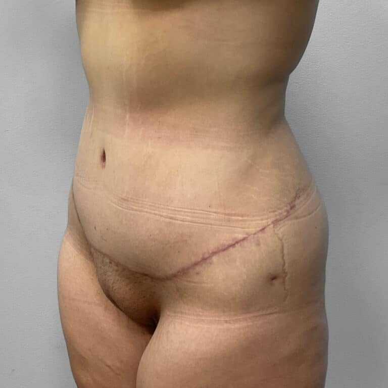 After Image: Tummy Tuck & Lipo- Dr. Howell - left-front-oblique