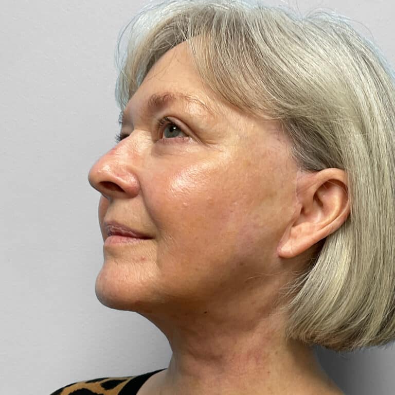 After Image: Facelift & TFX- Dr. Tucker - left-front-oblique