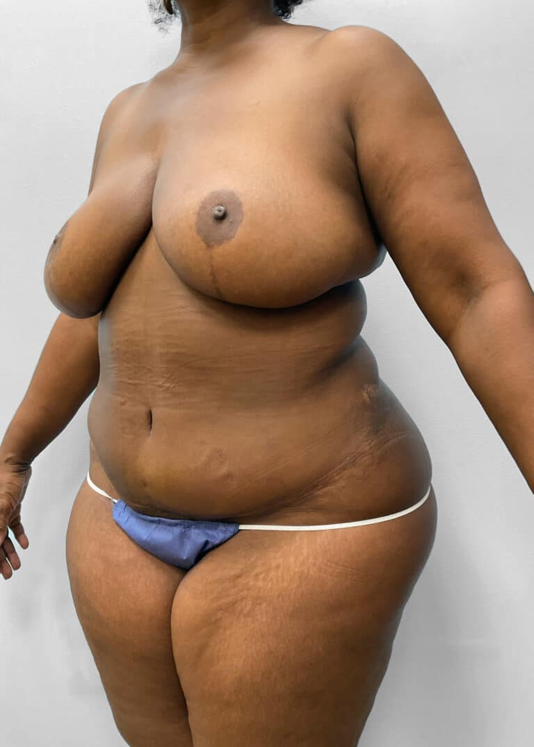 After Image: Tummy Tuck & Lipo- Dr. Tucker - left-front-oblique