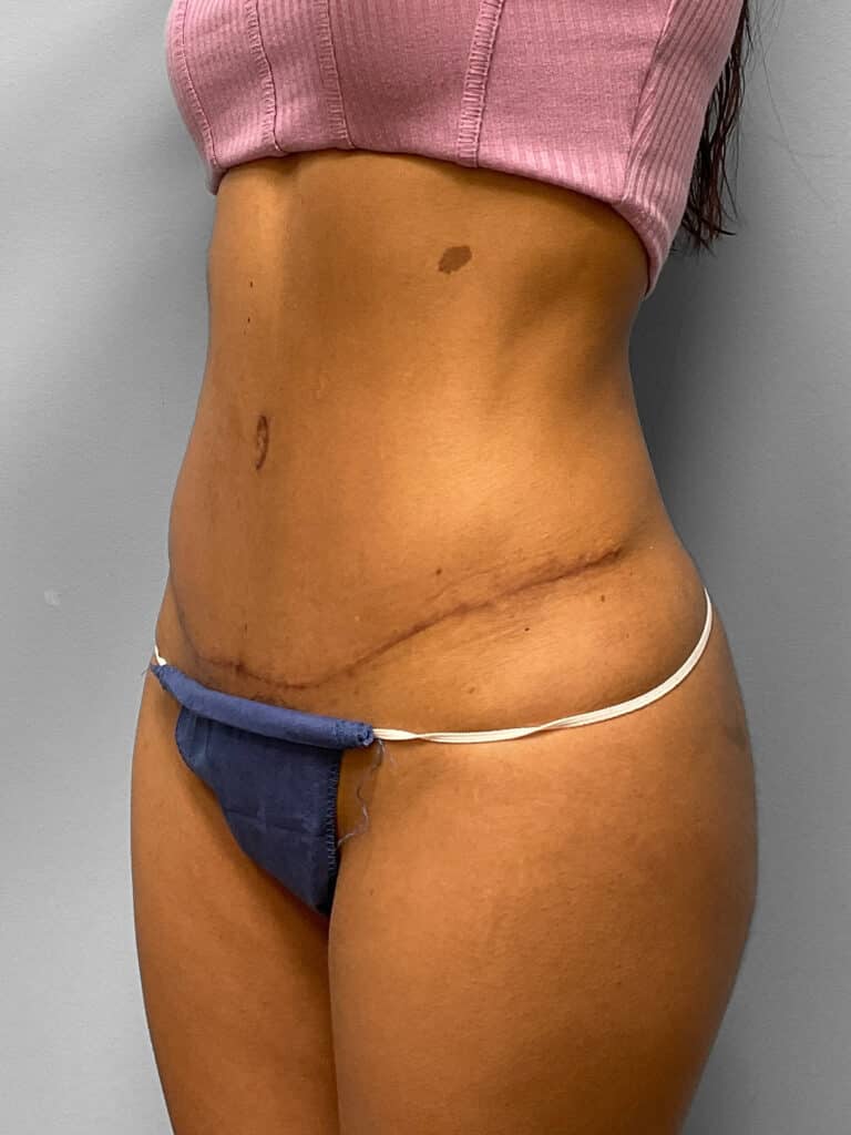 After Image: Tummy Tuck, Lipo, & BBL- Dr. Tucker - left-front-oblique