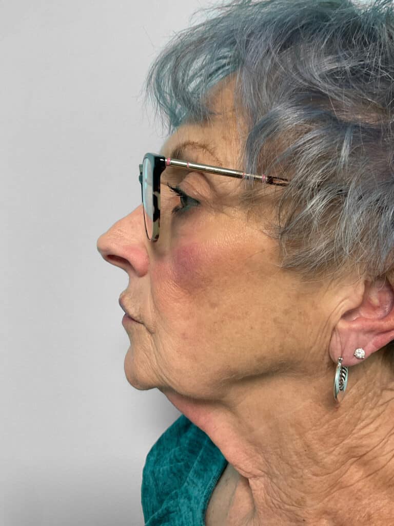 After Image: Botox & Restylane Kysse- Heather - left-side