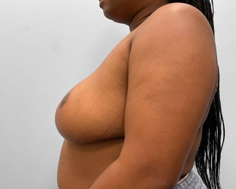 After Image: Breast Reduction- Dr. Tucker - left-side