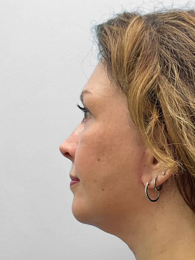 After Image: Facelift- Dr. Tucker - left-side