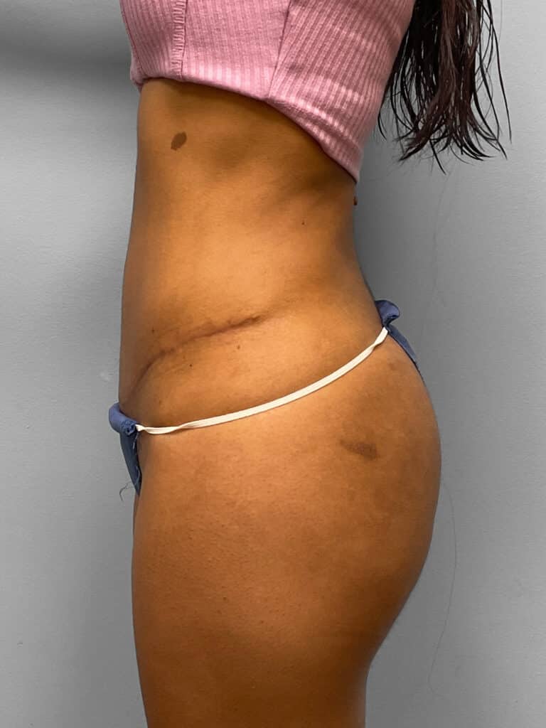 After Image: Tummy Tuck, Lipo, & BBL- Dr. Tucker - left-side