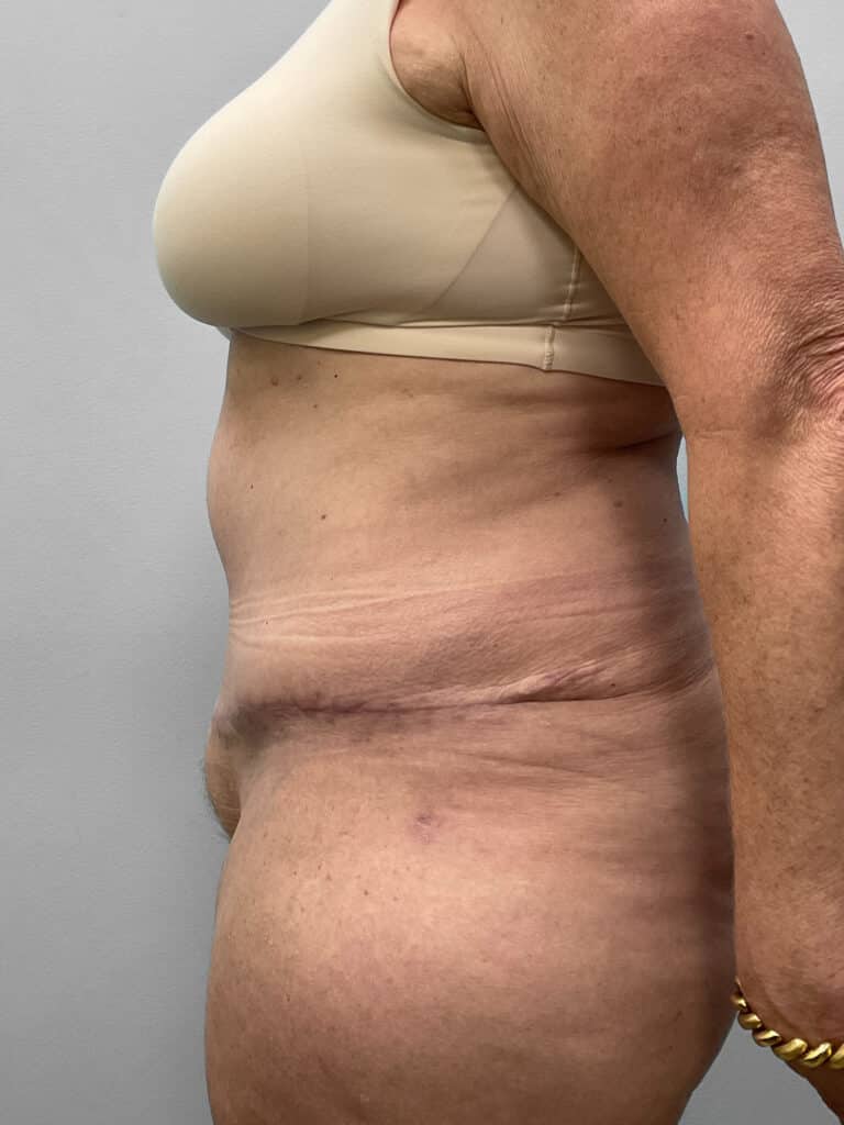 After Image: Abdominoplasty & Lipo- Dr. Howell - left-side