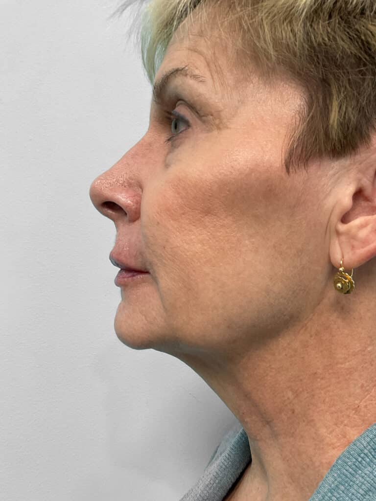 After Image: Juvederm Volbella- Heather - left-side