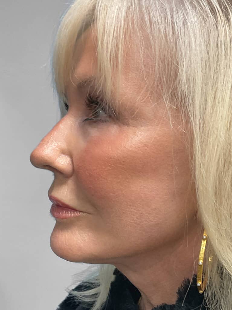 After Image: Facelift & TFX- Dr. Tucker - left-side