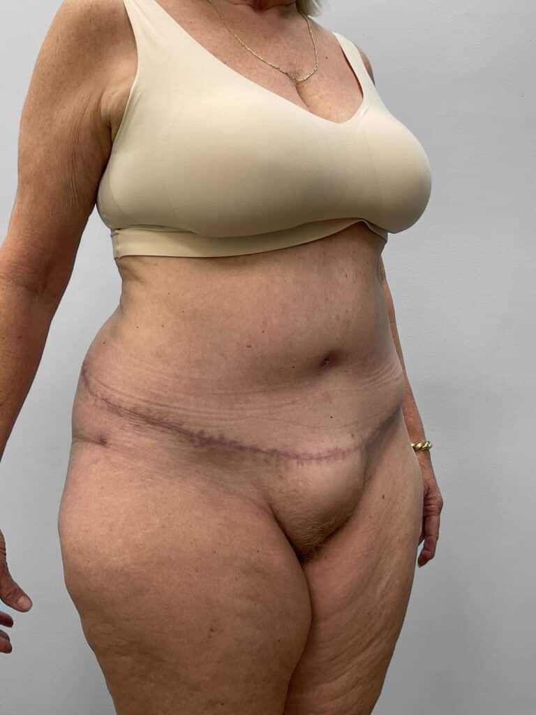 After Image: Abdominoplasty & Lipo- Dr. Howell - right-front-oblique