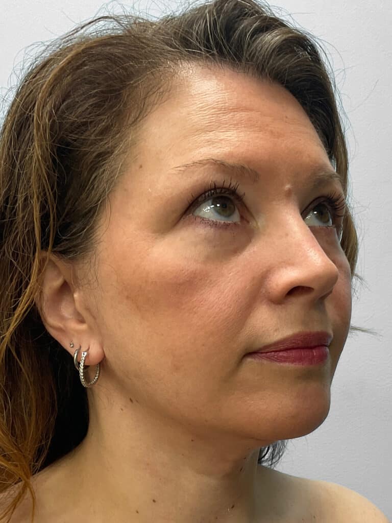 After Image: Facelift- Dr. Tucker - right-front-oblique