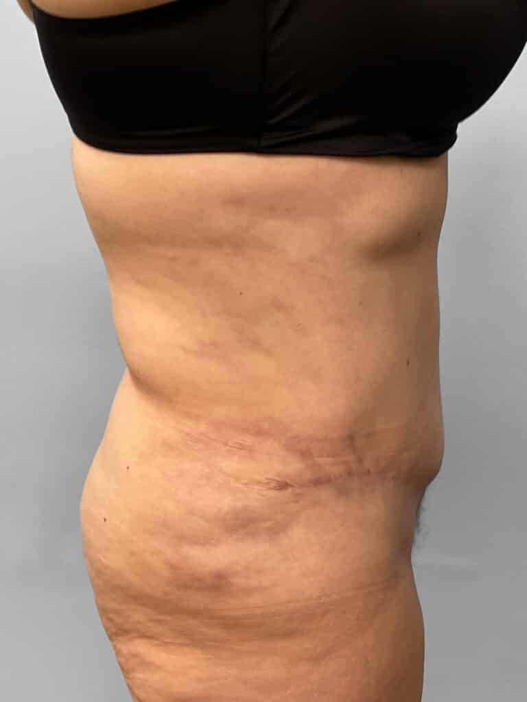 After Image: Tummy Tuck & Liposuction- Dr. Tucker - right-side