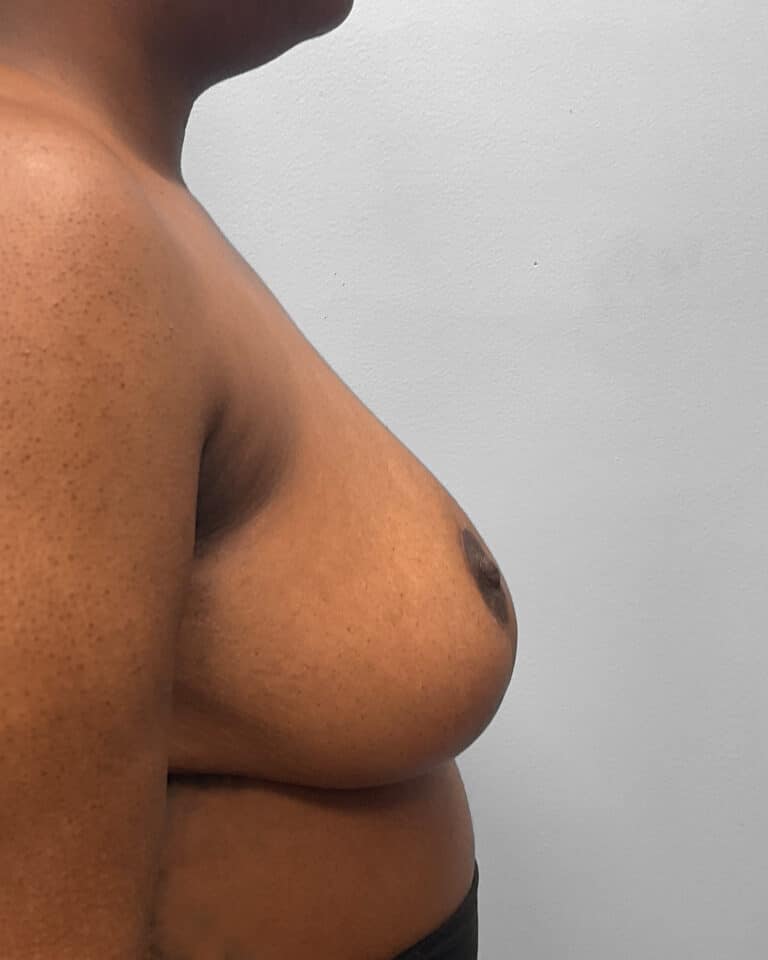 After Image: Breast Reduction- Dr. Tucker -