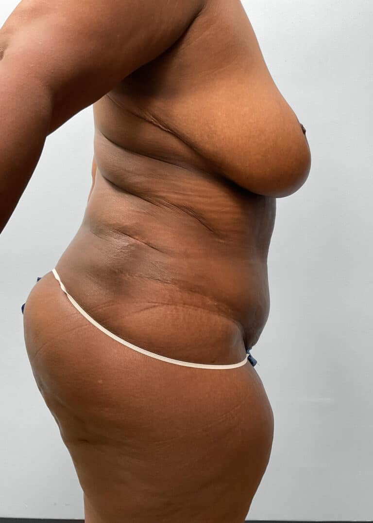 After Image: Tummy Tuck & Lipo- Dr. Tucker - right-side