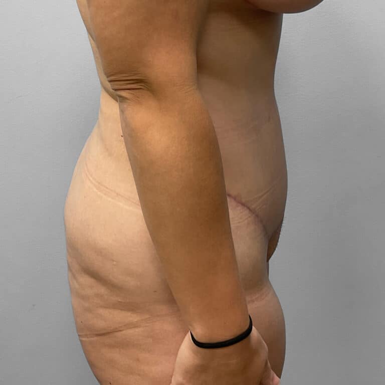 After Image: Tummy Tuck & Lipo- Dr. Howell - front