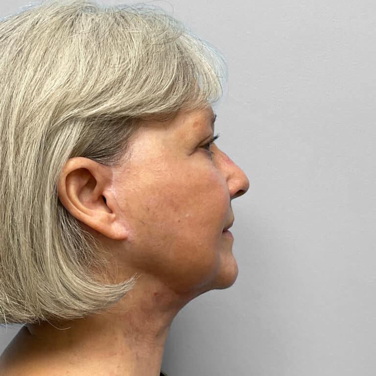 After Image: Facelift & TFX- Dr. Tucker - right-side