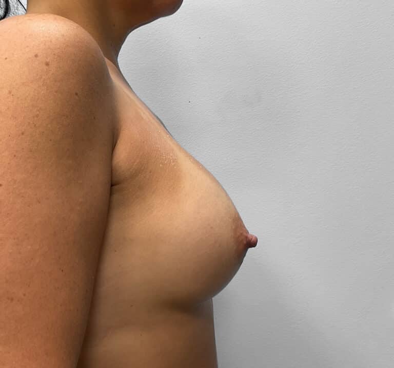 After Image: Breast Augmentation- Dr. Howell - right-side