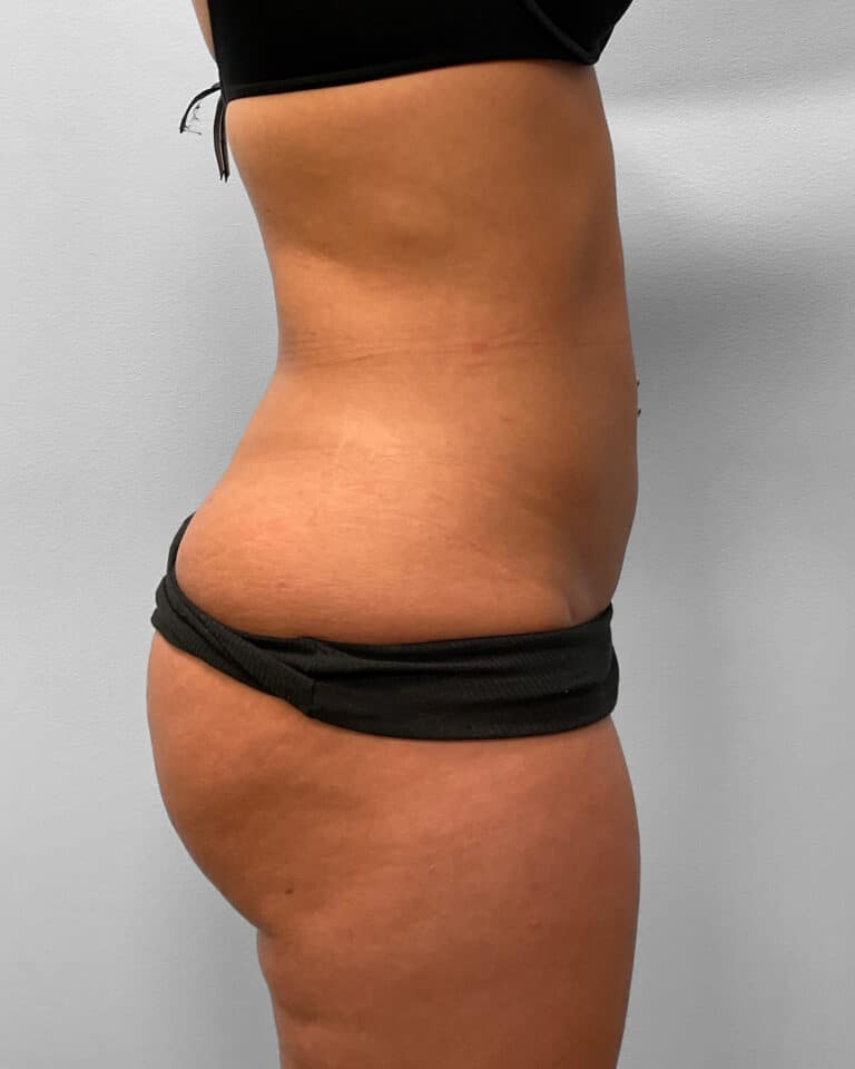 After Image: BBL & Liposuction- Dr. Howell - right-side