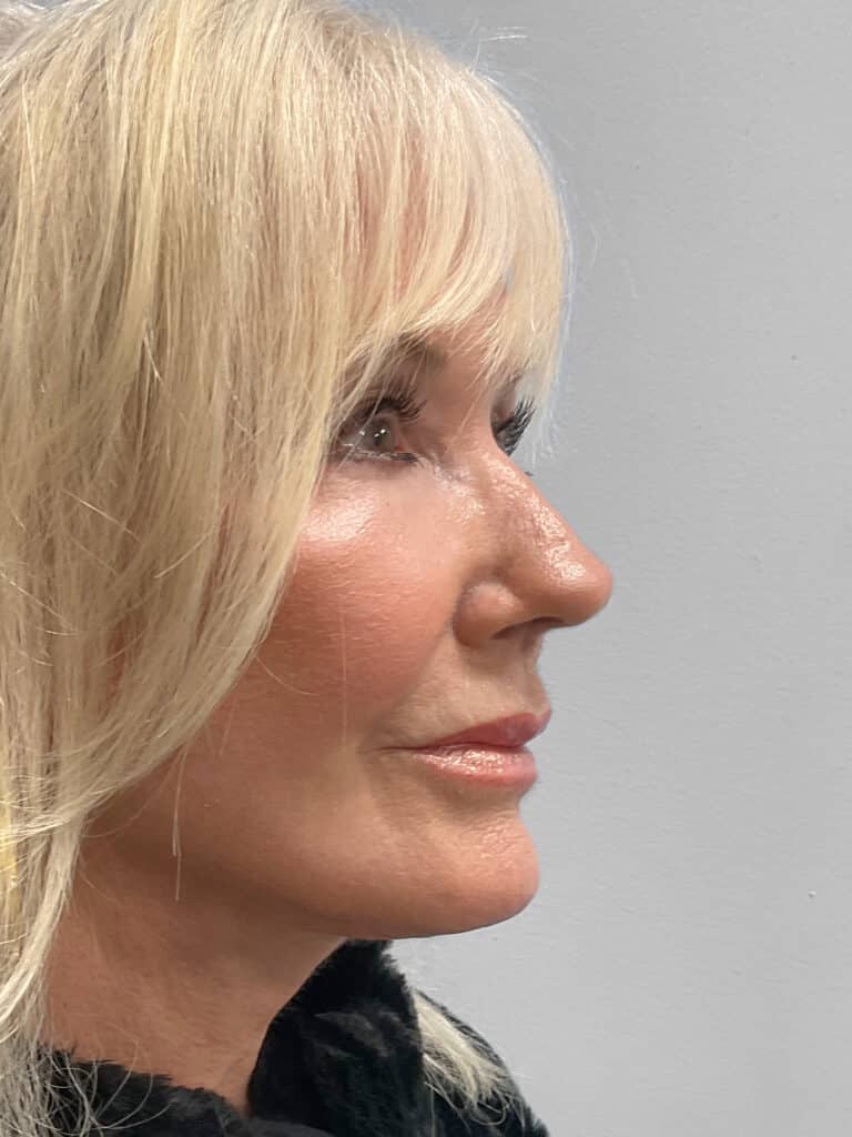 After Image: Facelift & TFX- Dr. Tucker - right-side