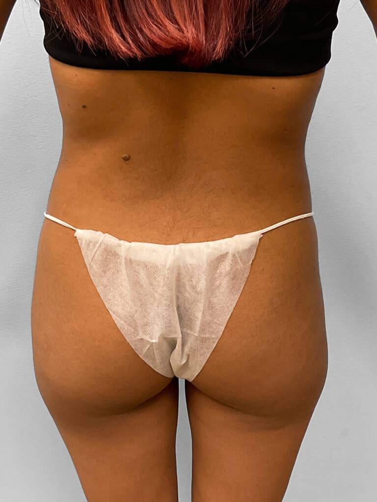 Before Image: Tummy Tuck, Lipo, & BBL- Dr. Tucker -