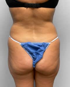 Before Image: BBL & Liposuction- Dr. Howell