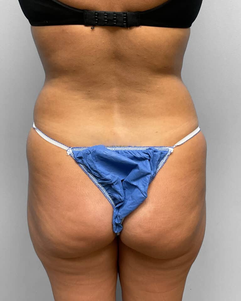 Before Image: BBL & Liposuction- Dr. Howell - back