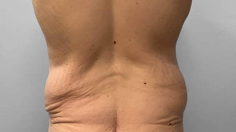 Before Image: Body Lift- Dr. Tucker - back