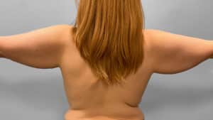 Before Image: Arm Lift- Dr. Tucker