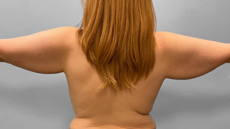 Before Image: Arm Lift- Dr. Tucker - front