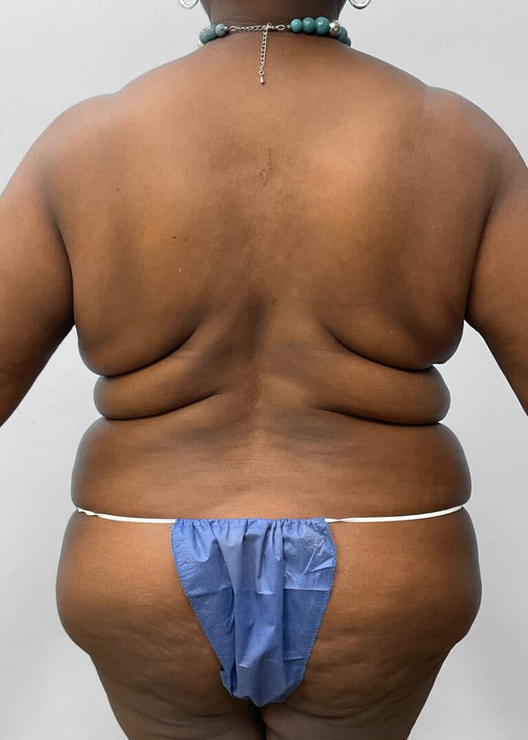 Before Image: Tummy Tuck & Lipo- Dr. Tucker - back