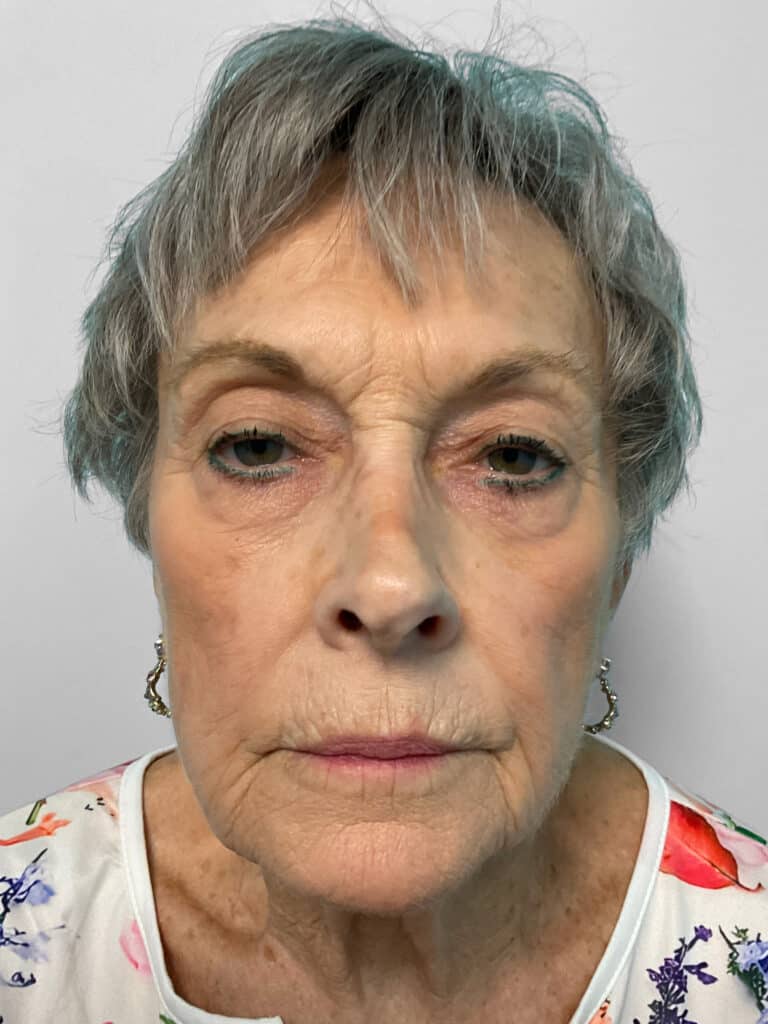Before Image: Botox & Restylane Kysse- Heather - front