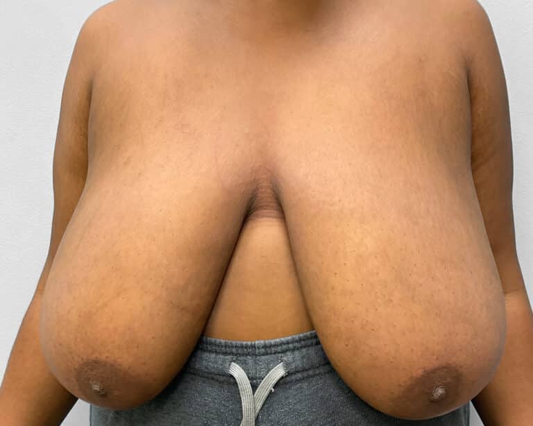 Before Image: Breast Reduction- Dr. Tucker - front