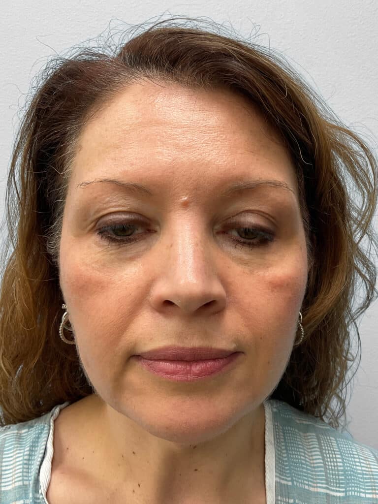 Before Image: Facelift- Dr. Tucker - front