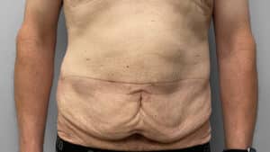 Before Image: Body Lift- Dr. Tucker
