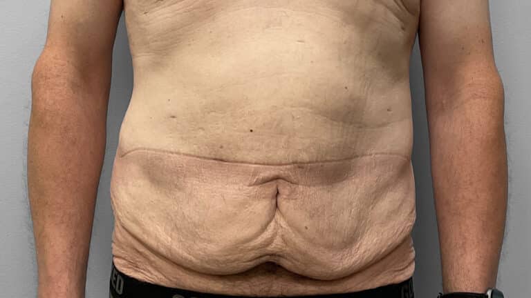 Before Image: Body Lift- Dr. Tucker - front