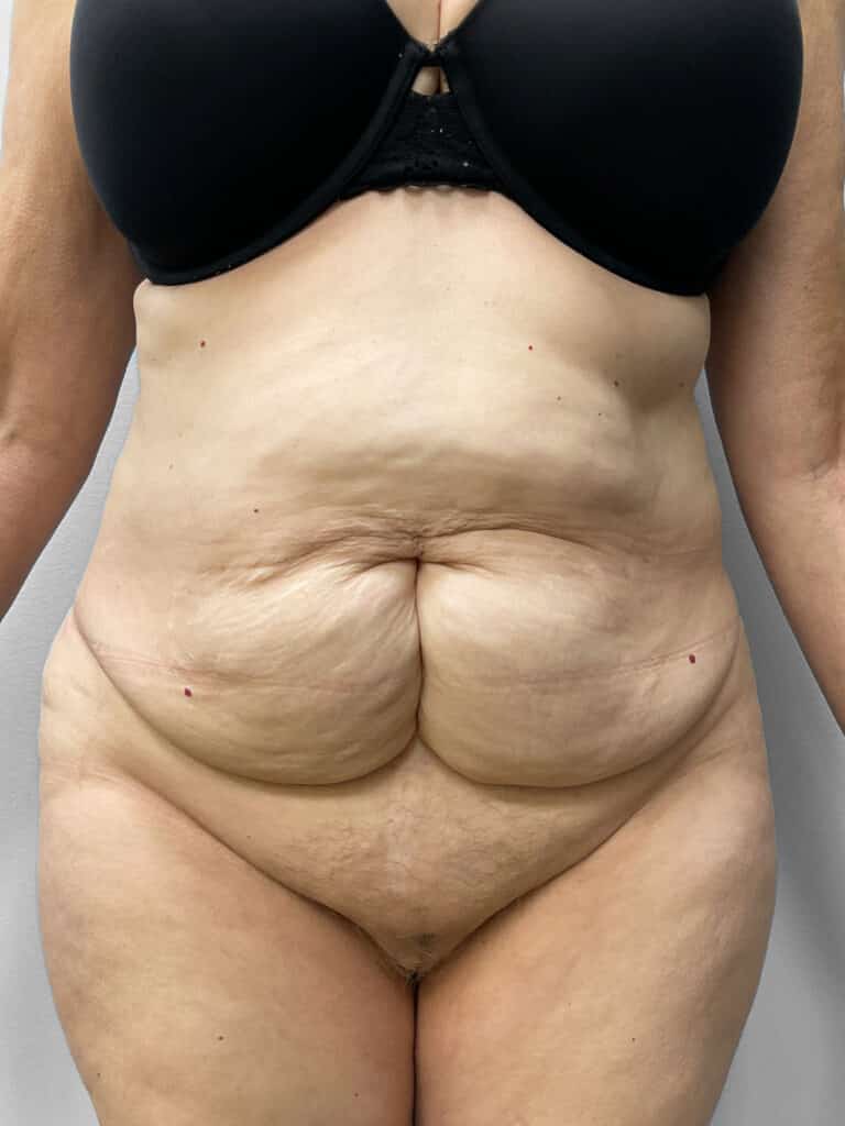 Before Image: Tummy Tuck & Liposuction- Dr. Tucker - front