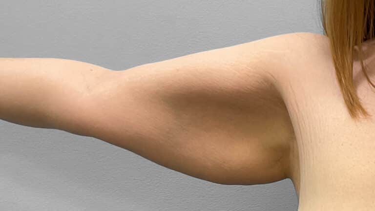 Before Image: Arm Lift- Dr. Tucker - right-side