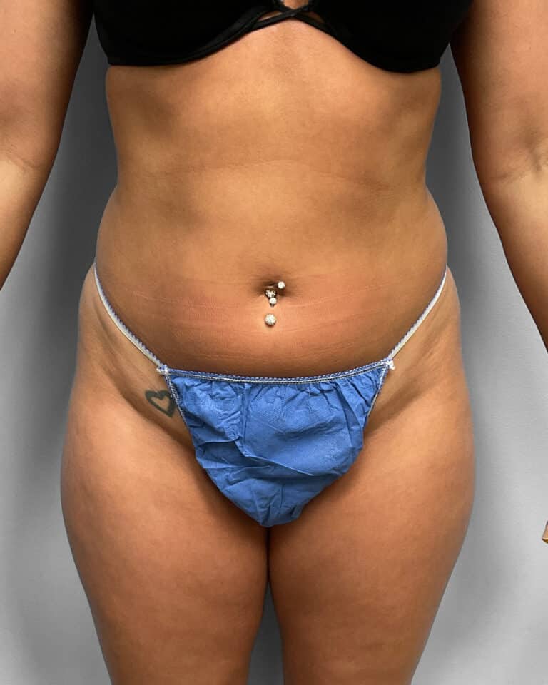 Before Image: BBL & Liposuction- Dr. Howell - front
