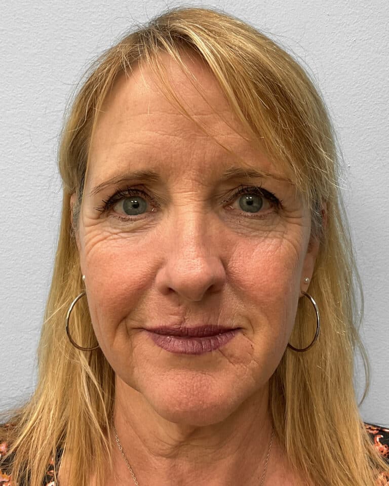 Before Image: Facelift & TFX- Dr. Tucker - front
