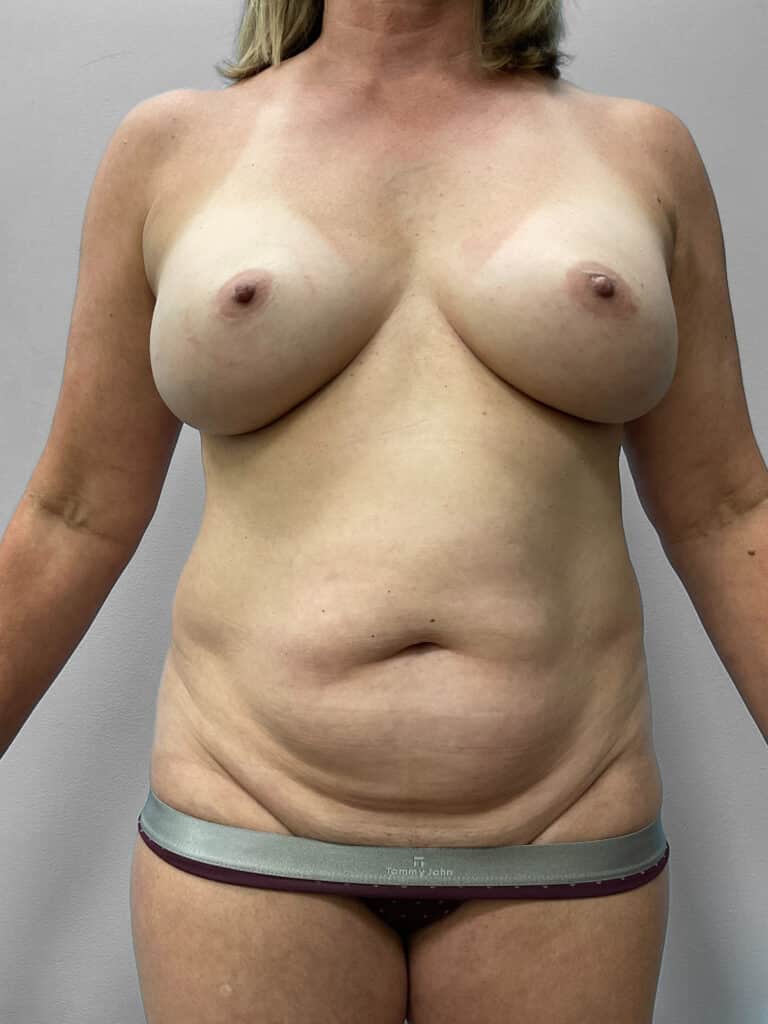 Before Image: Abdominoplasty and Lipo- Dr. Tucker - front