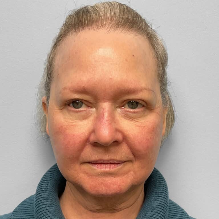 Before Image: Facelift & TFX- Dr. Tucker - front